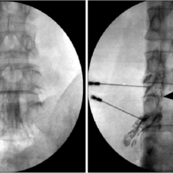 Cpt code for interlaminar epidural steroid injection